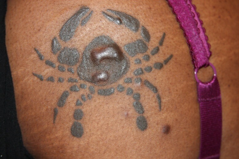 Tattoo Keloid